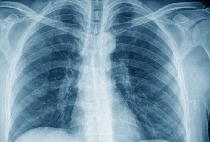 Bộ Y tế l&ecirc;n tiếng về việc BHYT kh&ocirc;ng thanh to&aacute;n X-quang dưới 6 ph&uacute;t - Ảnh 1.