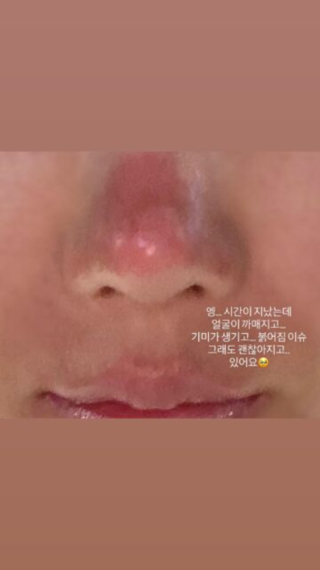 Nữ hoàng gợi cảm showbiz bị bỏng mặt, xót cho nhan sắc trời ban- Ảnh 1. Nữ hoàng gợi cảm showbiz bị bỏng mặt, xót cho nhan sắc trời ban- Ảnh 1.