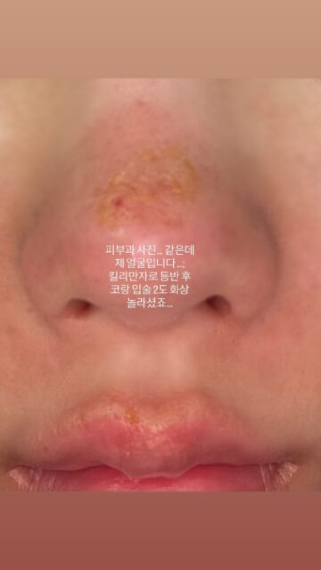 Nữ hoàng gợi cảm showbiz bị bỏng mặt, xót cho nhan sắc trời ban- Ảnh 2. Nữ hoàng gợi cảm showbiz bị bỏng mặt, xót cho nhan sắc trời ban- Ảnh 2.