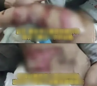 Bé Trai 1 Tuổi Bị Bỏng Nặng Do 