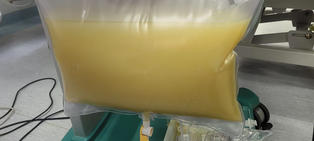 Nam sinh năm nhất "m&aacute;u trắng như sữa", mỡ m&aacute;u cao gấp 47 lần b&igrave;nh thường v&igrave; th&oacute;i quen ăn uống nhiều người mắc - Ảnh 2.