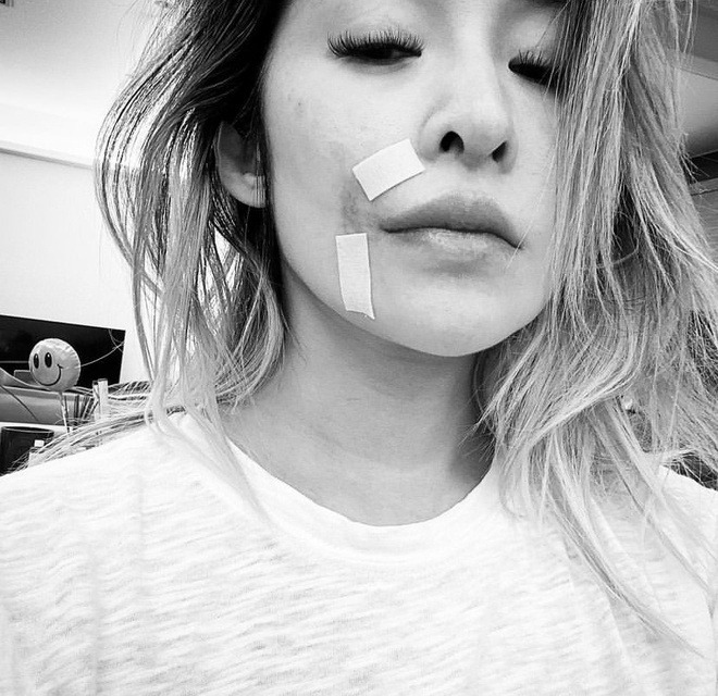 Nữ ca sĩ bị tai nạn đến hủy dung: Vết thương hoại tử 2 tháng, giờ gây sốc với 