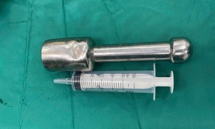 Thiếu ni&ecirc;n 15 tuổi mắc kẹt ch&agrave;y kim loại d&agrave;i 18 cm trong trực tr&agrave;ng - Ảnh 1.