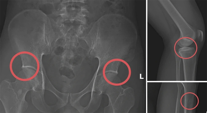 Thực nghiệm điều tra vụ tự đục vỡ xương trục lợi bảo hiểm 6 tỷ đồng tại Ph&uacute; Thọ - Ảnh 3.