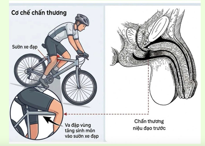 Cảnh Báo Chấn Thương Niệu Đạo Ở Trẻ Em Sau Tai Nạn Xe Đạp - Ảnh 1.