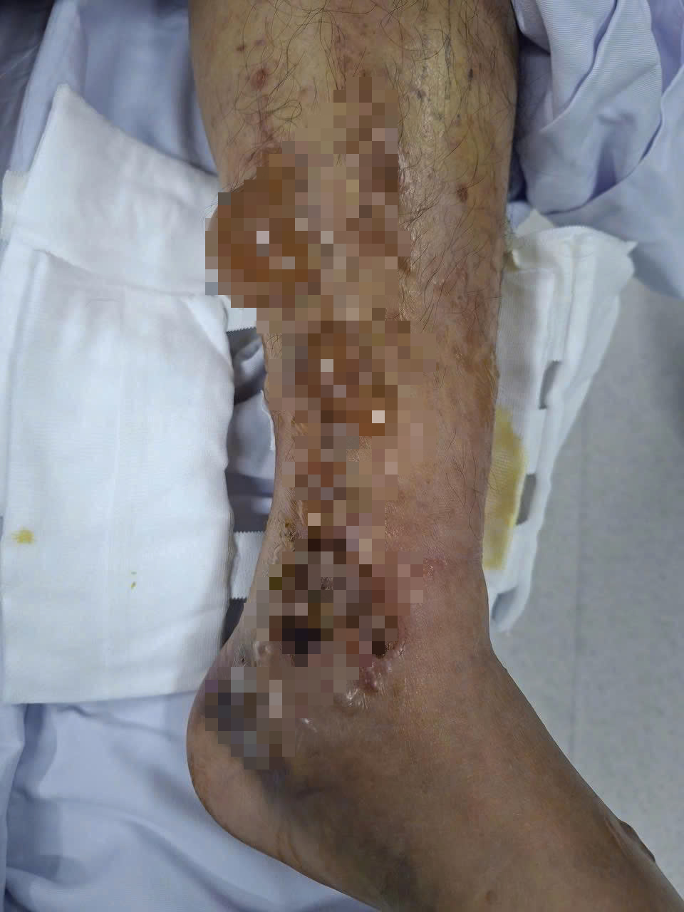 Đắp Lá, Một Người Đàn Ông Suýt Mất Chân - Ảnh 3.