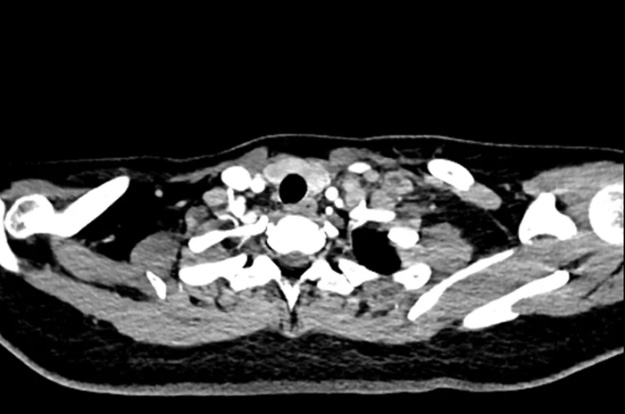 Nữ Sinh 20 Tuổi Đau Cổ, Đi Khám Phát Hiện Ung Thư Dạ Dày Đã Di Căn Toàn Thân: Đừng Bỏ Qua Dấu Hiệu Này - Ảnh 1.