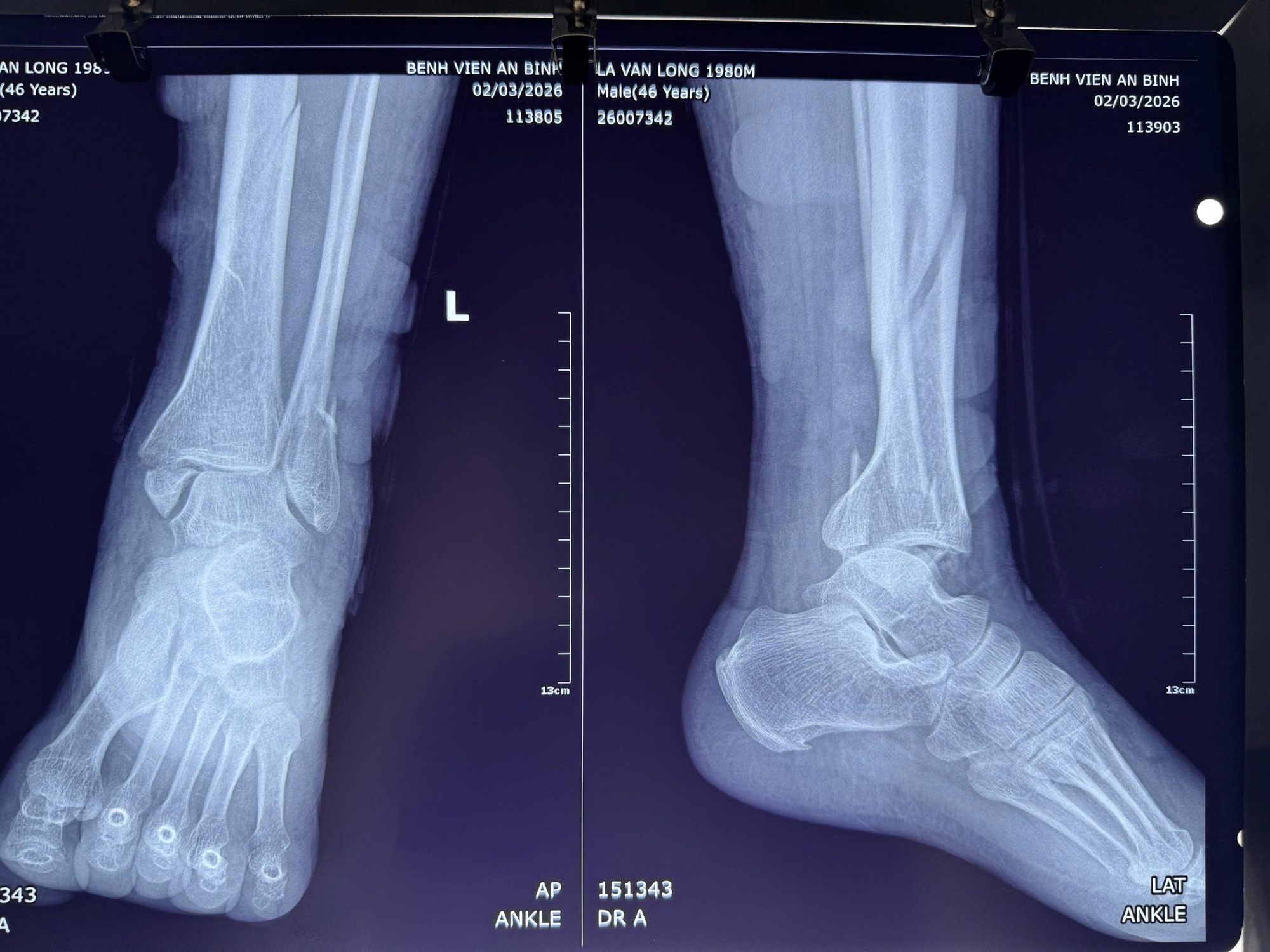 Đắp Lá, Một Người Đàn Ông Suýt Mất Chân - Ảnh 2.