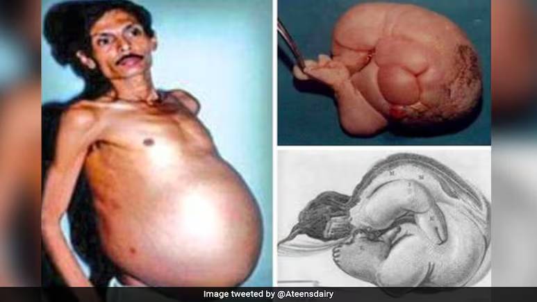 Người đ&agrave;n &ocirc;ng 60 tuổi "mang thai" suốt 36 năm, nh&oacute;m b&aacute;c sĩ kinh ho&agrave;ng khi tiến h&agrave;nh phẫu thuật - Ảnh 1.