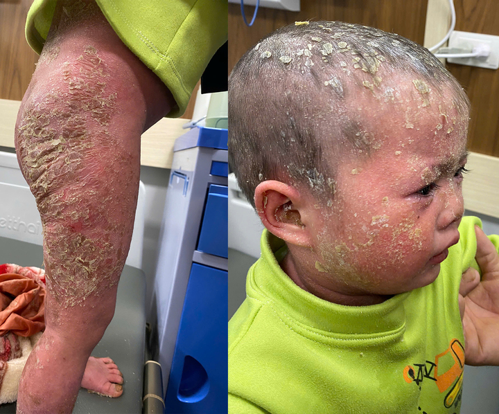 'Con đau lắm, bố ơi'-tiếng kh&oacute;c x&eacute; l&ograve;ng của b&eacute; g&aacute;i 3 tuổi c&oacute; l&agrave;n da như 'lửa thi&ecirc;u' - Ảnh 1.