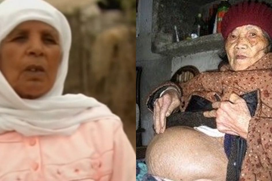 Người phụ nữ mang thai suốt 46 năm m&agrave; kh&ocirc;ng hề hay biết cho đến khi ngo&agrave;i 70 tuổi - Ảnh 1.