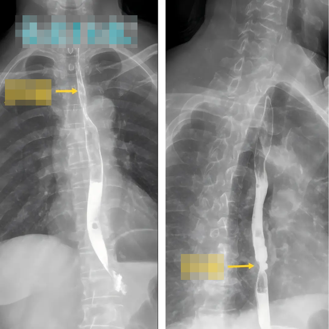 2 vợ chồng c&ugrave;ng mắc ung thư thực quản v&igrave; loại nước nhiều người th&iacute;ch uống: Uống mỗi ng&agrave;y l&agrave;m tăng gấp 6 lần nguy cơ ung thư - Ảnh 2.