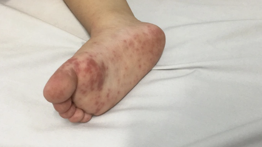 Dịch tay ch&acirc;n miệng &ldquo;n&oacute;ng&rdquo; trở lại, trẻ nhỏ đối mặt nguy cơ biến chứng nặng - Ảnh 2.