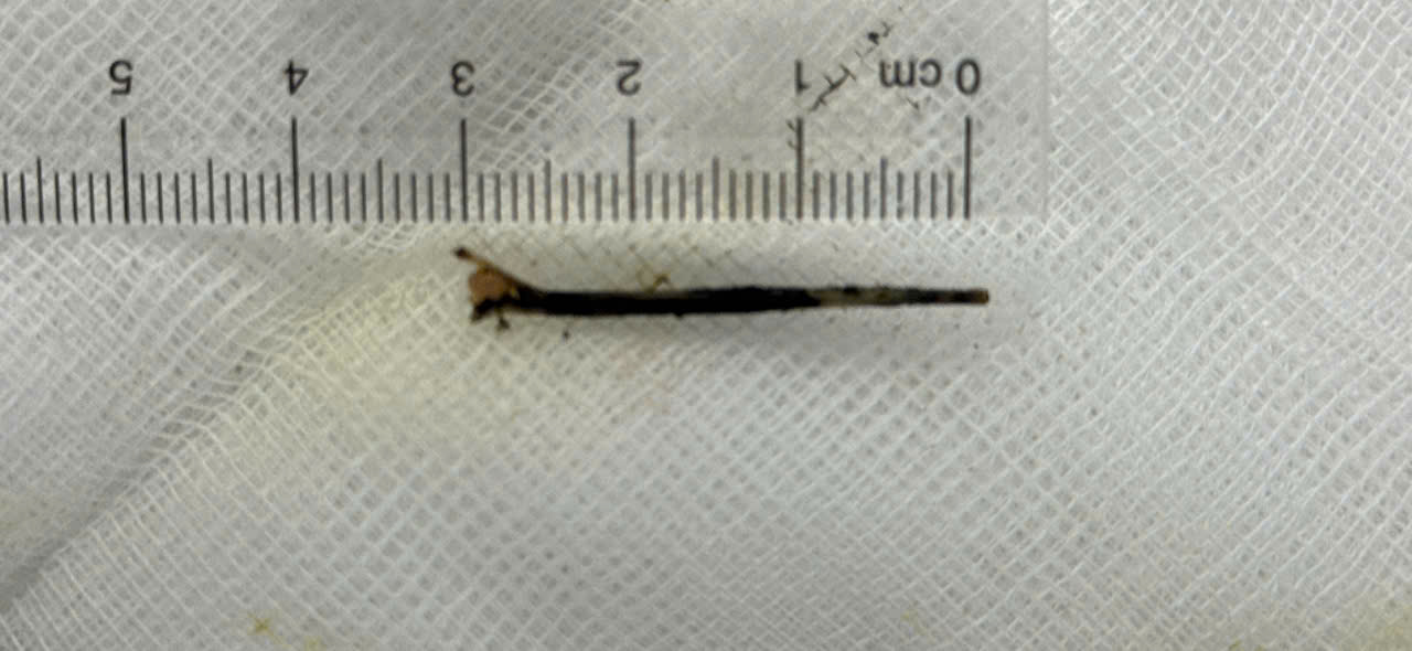 Mảnh xương c&aacute; l&agrave; &ldquo;thủ phạm&rdquo; khiến người đ&agrave;n &ocirc;ng ở Cần Thơ bị v&agrave;ng da như&hellip; nghệ - Ảnh 2.