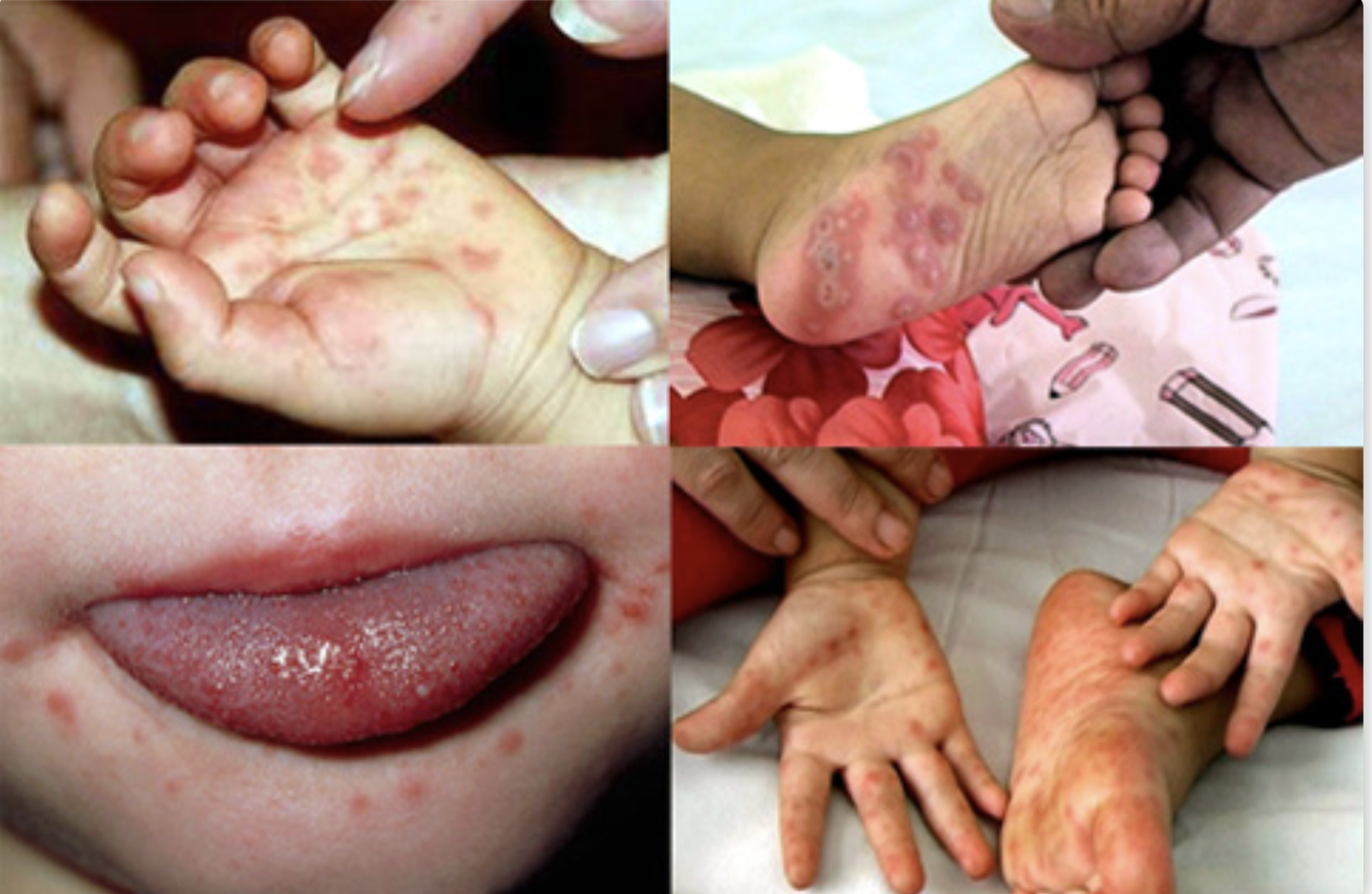 Sốt xuất huyết tăng 2,2 lần, tay ch&acirc;n miệng gấp 5 lần - Ảnh 2.