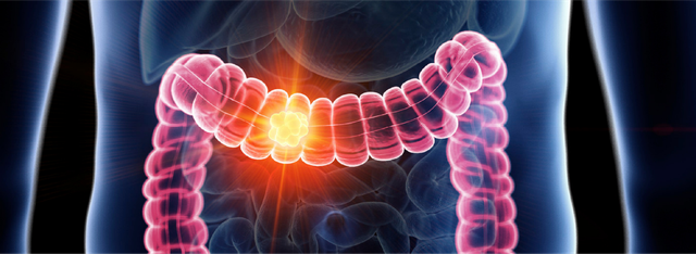 Kh&ocirc;ng phải gan hay phổi, đ&acirc;y mới l&agrave; loại ung thư g&acirc;y tử vong nhiều nhất ở người trẻ- Ảnh 1.