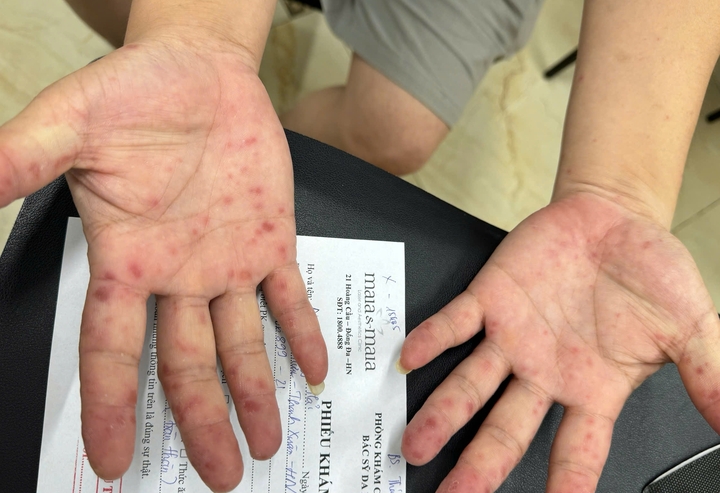 benh tay chan mieng 21470811 1774747369950 17747473711101488870427