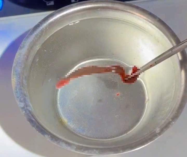 Dị vật kh&ocirc;ng ngờ b&aacute;m nhiều ng&agrave;y trong mũi bệnh nh&acirc;n 38 tuổi - Ảnh 2.