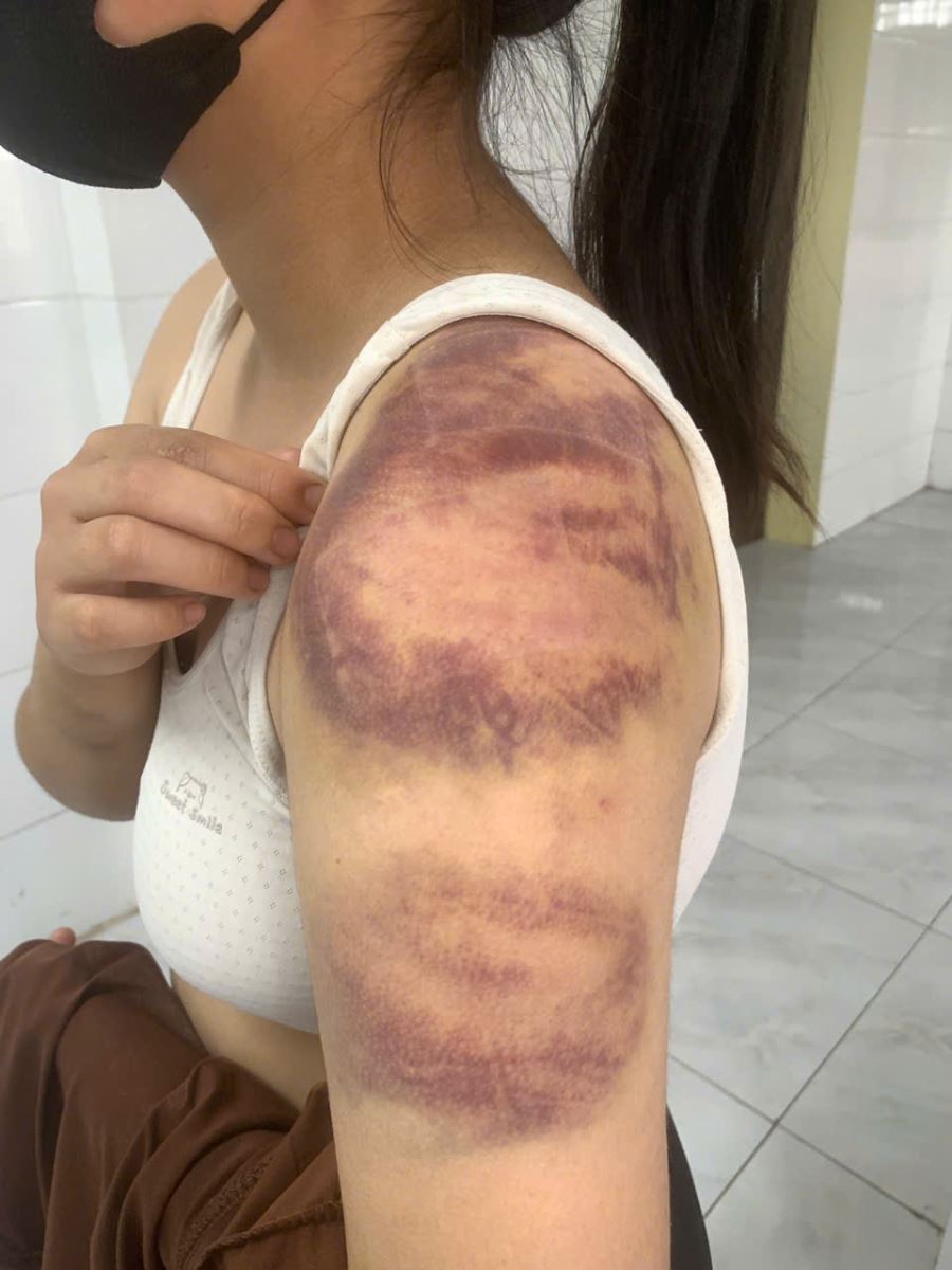 H&agrave;nh vi bạo h&agrave;nh gia đ&igrave;nh: Vụ tr&oacute;i tay , đ&aacute;nh đập con g&aacute;i tại Bắc Ninh - Ảnh 2.