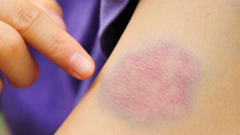 14 Dau Hieu Cua Benh Gan Va Cac Benh Ve Gan 12 800X450 1773047522597 1773047523176452388385