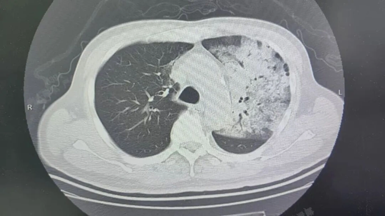 Người đ&agrave;n &ocirc;ng sốt 40 độ C, phổi gần như &ldquo;trắng x&oacute;a&rdquo;, chỉ v&agrave;i ng&agrave;y đ&atilde; suy đa tạng: Thủ phạm li&ecirc;n quan đến th&oacute;i quen nhiều gia đ&igrave;nh vẫn mắc - Ảnh 1.