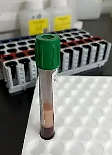 Người đàn ông đi khám khó tiêu phát hiện máu đục như sữa dâu, bác sĩ tức giận: "Sướng cái miệng, hại cái thân" 20 nguoi dan ong di kham kho tieu phat hien mau duc nhu sua dau bac si tuc gian suong cai mieng hai cai than anh2 231708 1775785627080 17757856273331931654052