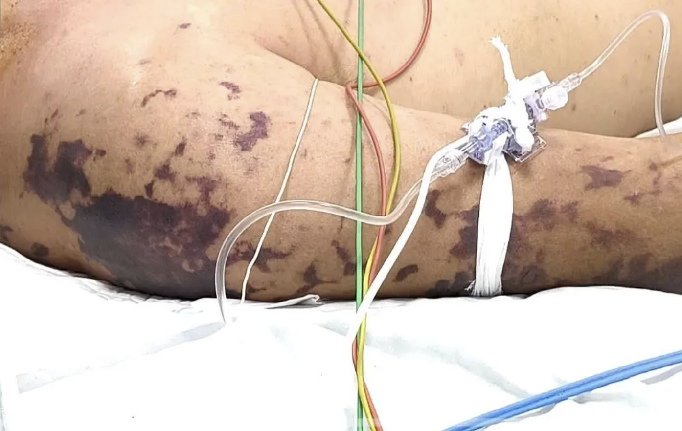 4 ca tử vong do n&atilde;o m&ocirc; cầu, Bộ Y tế cảnh b&aacute;o nguy cơ - Ảnh 1.