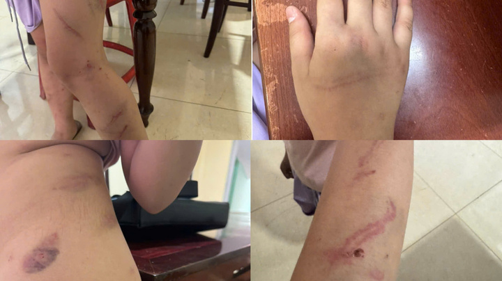 X&aacute;c minh vụ b&eacute; g&aacute;i 9 tuổi bị bạo h&agrave;nh trẻ em với 34 vết bầm ở Đắk Lắk - Ảnh 1.