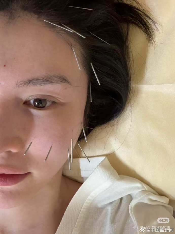 Vợ tổng t&agrave;i hot nhất Trung Quốc ghim h&agrave;ng chục c&acirc;y kim l&ecirc;n mặt để ngăn xệ sau sinh- Ảnh 2.