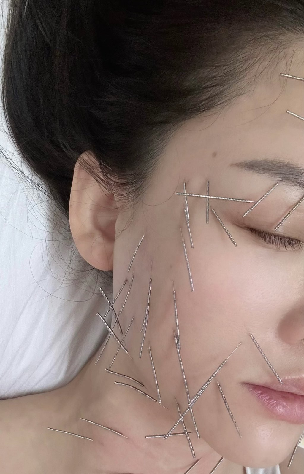 Vợ tổng t&agrave;i hot nhất Trung Quốc ghim h&agrave;ng chục c&acirc;y kim l&ecirc;n mặt để ngăn xệ sau sinh- Ảnh 3.