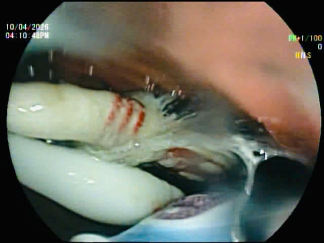 Người đ&agrave;n &ocirc;ng nuốt c&ugrave;ng l&uacute;c 3 b&agrave;n chải đ&aacute;nh răng v&agrave;o bụng - Ảnh 2.