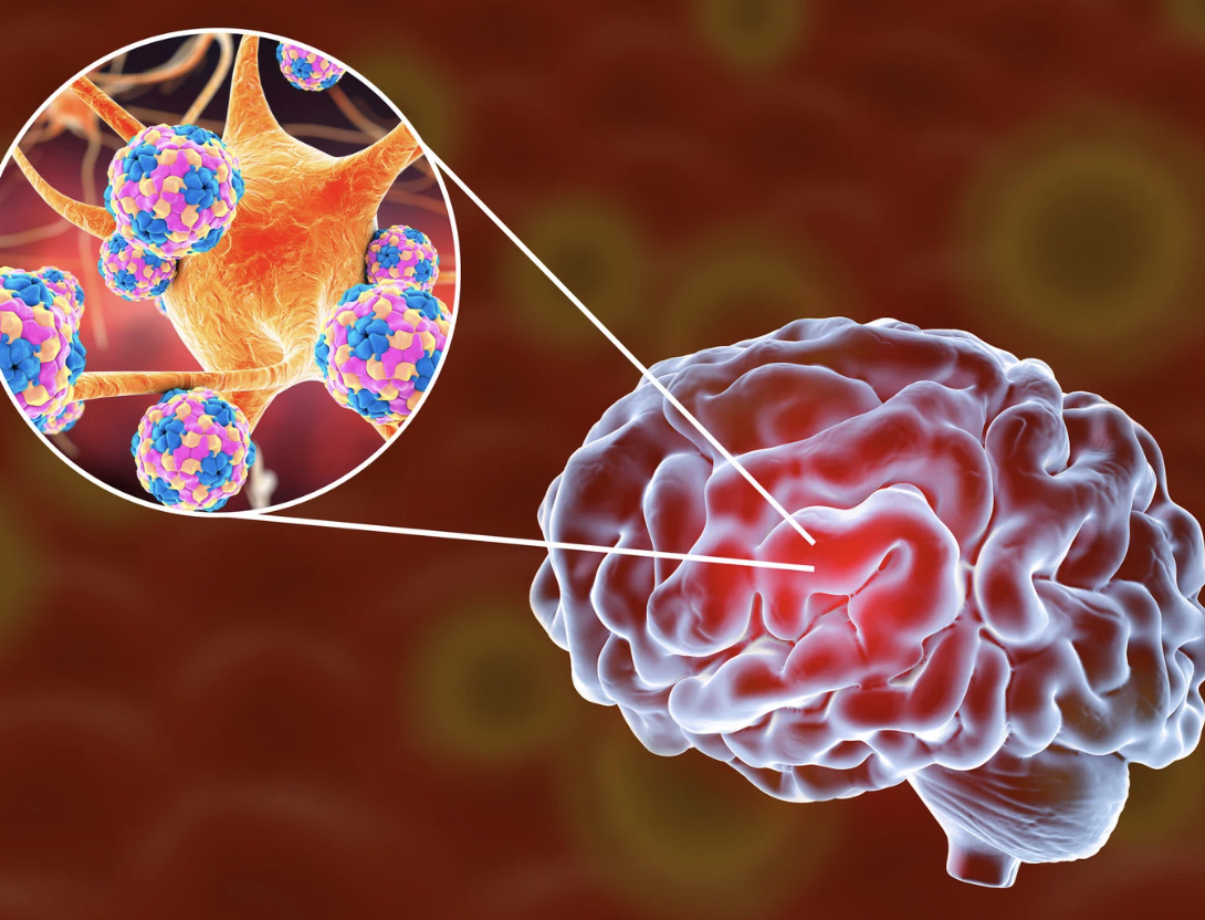 Bệnh nhi 11 tuổi bị vi&ecirc;m n&atilde;o m&ocirc; cầu đ&atilde; kh&ocirc;ng qua khỏi - Ảnh 1.