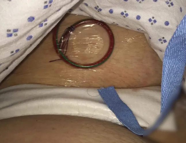 Ch&agrave;ng trai 26 tuổi phải cắt bỏ hơn 10cm "cậu nhỏ" v&igrave; bỏ qua 1 thứ ai cũng tưởng tắm... chưa kỹ - Ảnh 3.