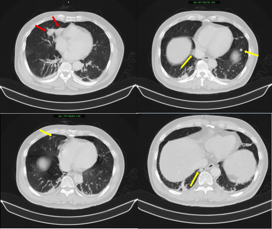 Chỉ c&oacute; 1 dấu hiệu, đi kh&aacute;m ph&aacute;t hiện mắc c&ugrave;ng l&uacute;c 2 bệnh ung thư: Cảnh b&aacute;o từ b&aacute;c sĩ ung bướu - Ảnh 1.