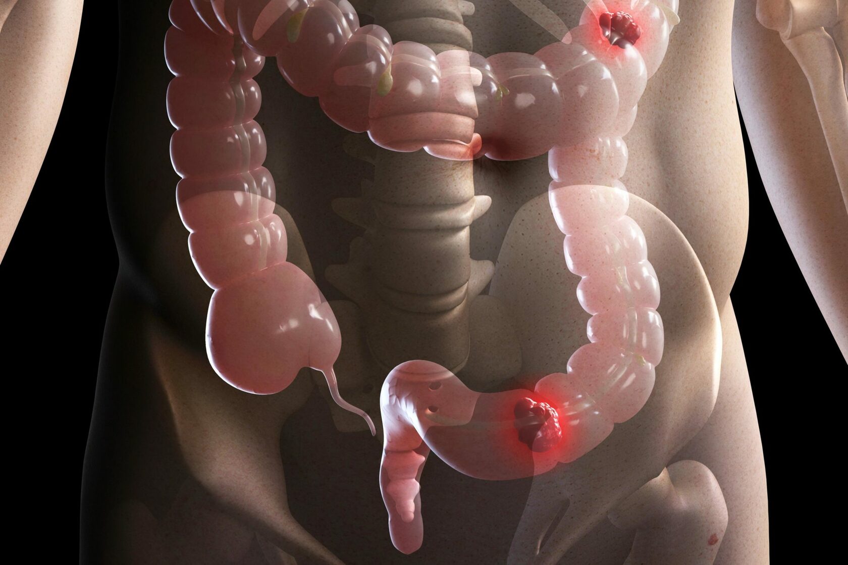 Ph&aacute;t hiện ung thư giai đoạn 4 ở tuổi 26, nam thanh ni&ecirc;n hối hận: Gi&aacute; như t&ocirc;i kh&ocirc;ng bỏ qua triệu chứng n&agrave;y - Ảnh 2.