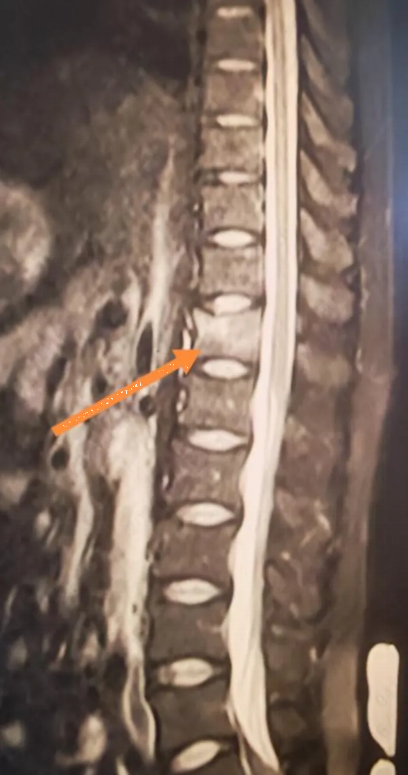 Người đàn ông 34 tuổi xương giòn như bà cụ 60 tuổi vì ngày nào cũng uống 3 cốc loại nước nhiều người không thể sống thiếu - Ảnh 1.