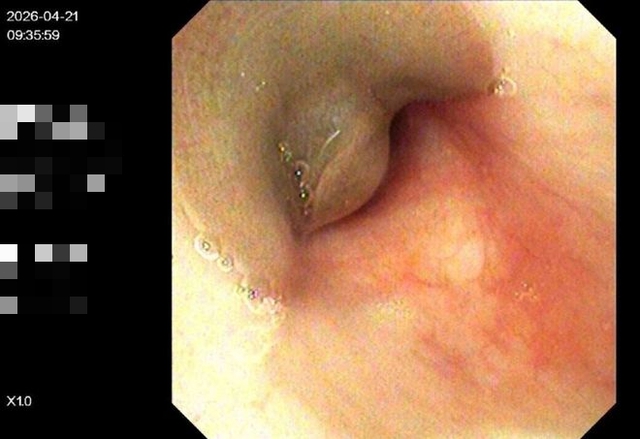 Bé trai 8 tuổi ho ra máu suốt 10 ngày, bác sĩ gắp được 