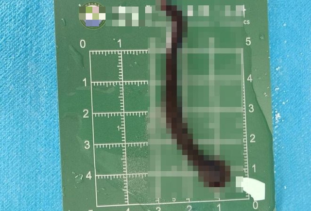 Bé trai 8 tuổi ho ra máu suốt 10 ngày, bác sĩ gắp được 