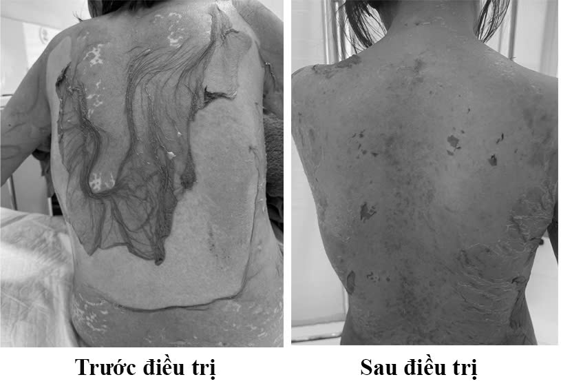 Hải Phòng: 1 phụ nữ 35 tuổi bị tróc da như 