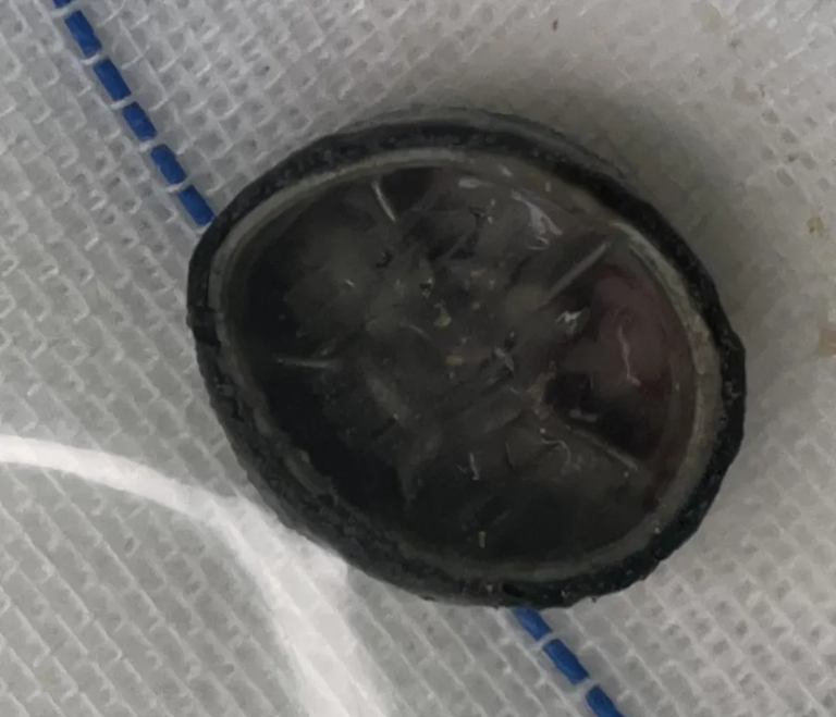 B&eacute; g&aacute;i 6 tuổi chảy m&aacute;u v&ugrave;ng k&iacute;n suốt 4 năm, đi kh&aacute;m mới ph&aacute;t hiện thứ &ldquo;kh&ocirc;ng ai ngờ&rdquo; b&ecirc;n trong- Ảnh 1.