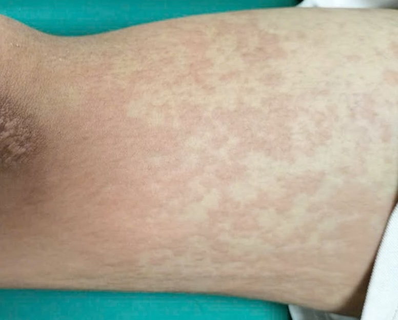 Ăn 2 con ve sầu, nam sinh sốc phản vệ phải cấp cứu l&uacute;c nửa đ&ecirc;m - Ảnh 1.