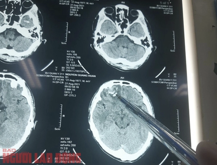 Gi&aacute;m đốc C&ocirc;ng an Gia Lai chỉ đạo điều tra vụ đ&aacute;nh người thương tật 35 % - Ảnh 1.