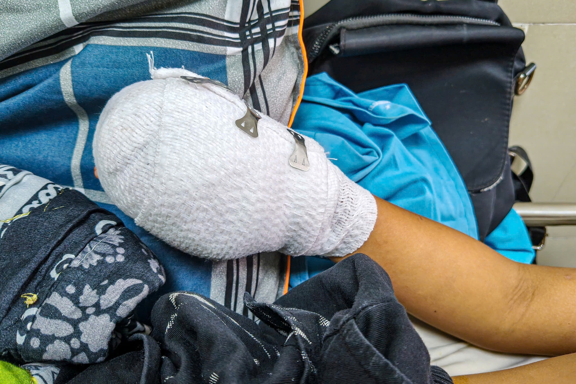 Ch&aacute;u b&eacute; bị dập b&agrave;n tay nghi do điện thoại nổ l&uacute;c sạc pin - Ảnh 2.