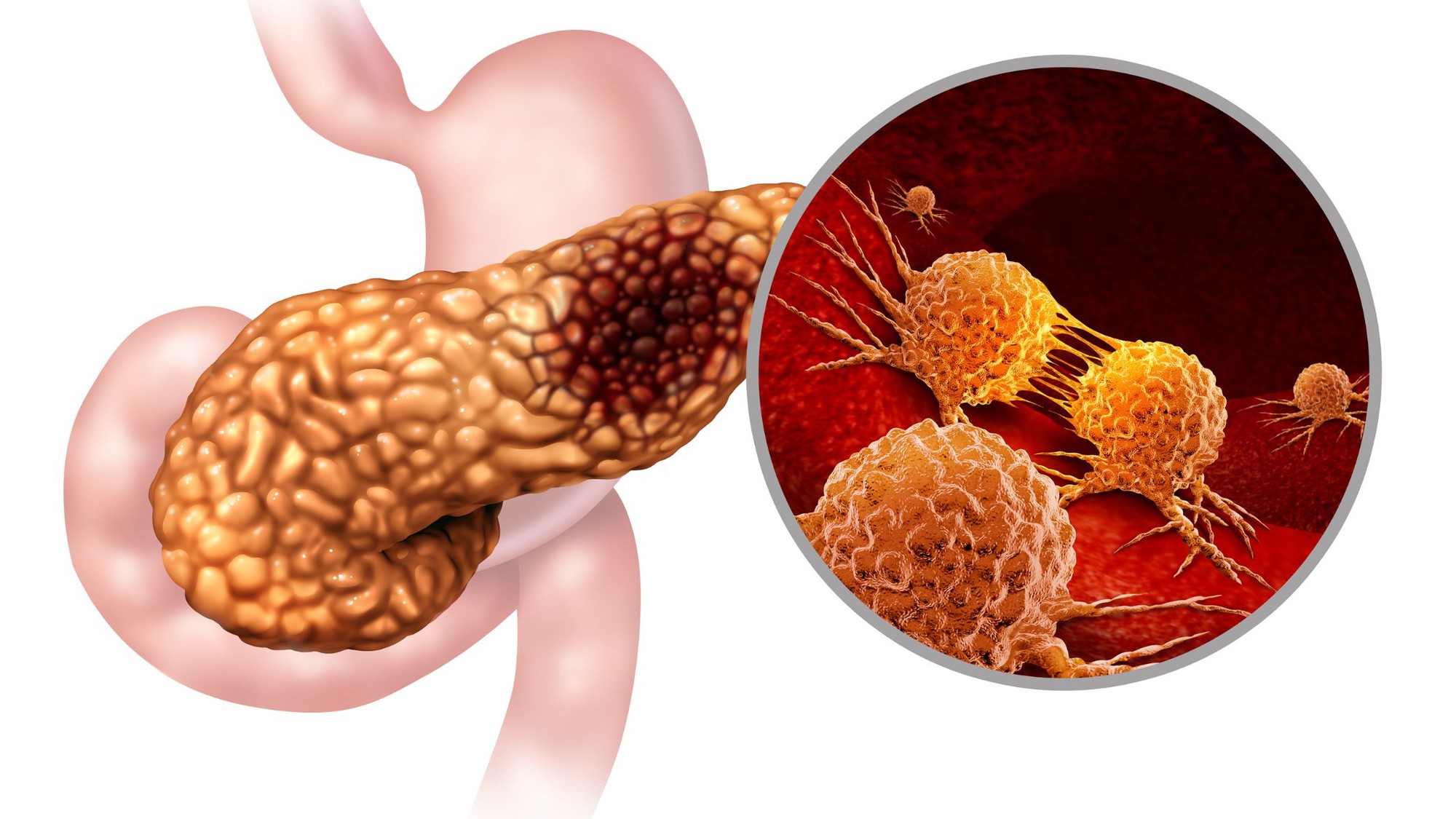 3 người trong 1 nh&agrave; đều mắc ung thư tuyến tụy: Bất ngờ với "thủ phạm" - Ảnh 1.