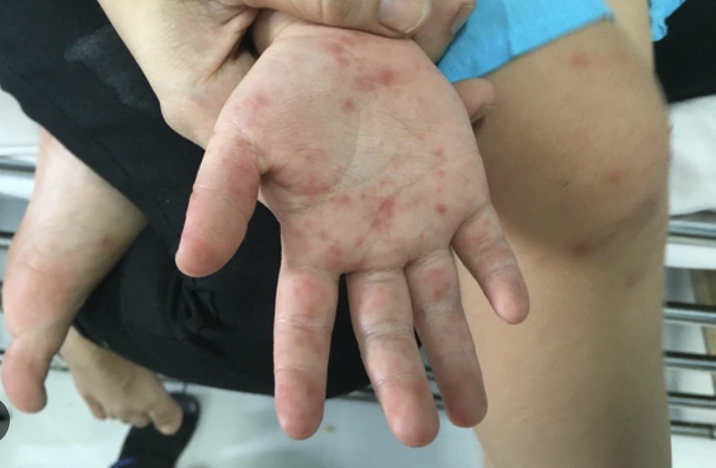Bác sĩ Bệnh viện Nhi đồng 1: Làm gì để tay chân miệng không còn tử vong, không để lại di chứng? - Ảnh 1.