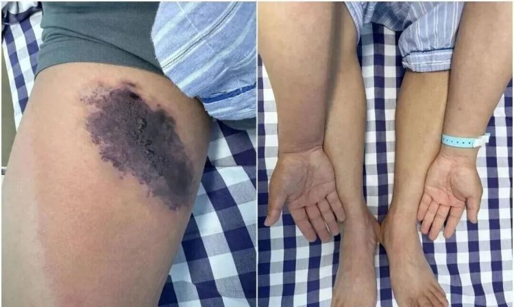 Cảnh gi&aacute;c với nhện cắn: H&agrave;nh tr&igrave;nh su&yacute;t nhiễm độc to&agrave;n th&acirc;n - Ảnh 1.