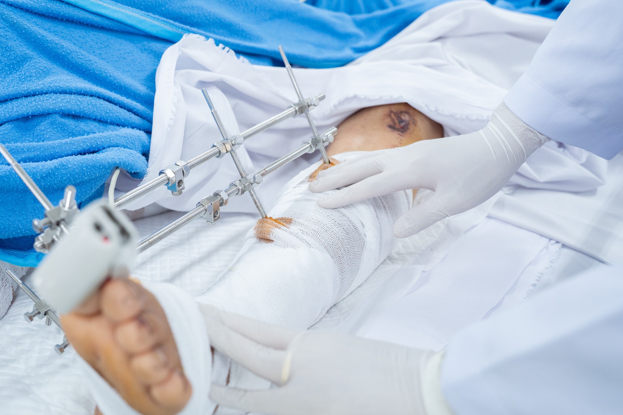 Bác sĩ Bệnh viện Chợ Rẫy mổ xuyên đêm cứu 2 nạn nhân vụ xe khách rơi xuống vực 20 Bác sĩ Bệnh viện Chợ Rẫy mổ xuyên đêm cứu 2 nạn nhân vụ xe khách rơi xuống vực - Ảnh 2.