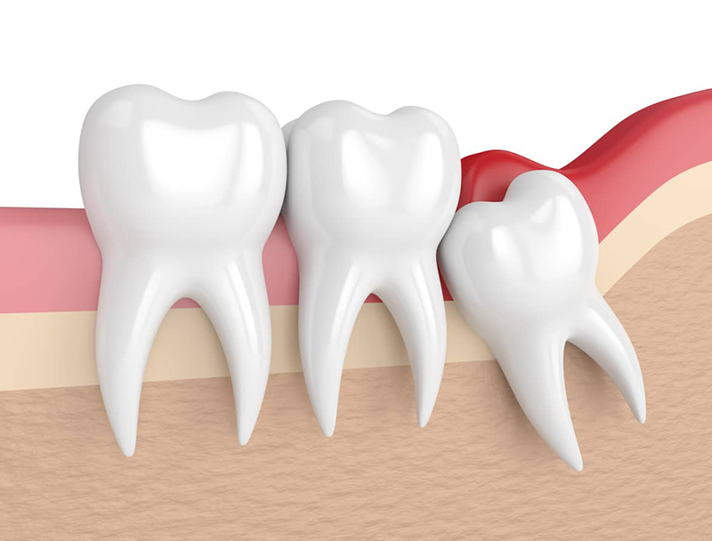 Nhổ răng kh&ocirc;n c&oacute; được BHYT chi trả kh&ocirc;ng? - Ảnh 1.