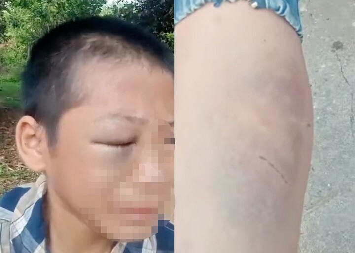 B&eacute; trai 11 tuổi ở Nghệ An nghi bị bạo h&agrave;nh trẻ em từ bố v&agrave; mẹ kế - Ảnh 1.