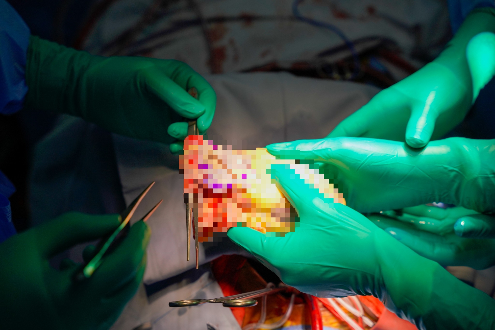 Tr&aacute;i tim bỗng đập trở lại trong lồng ngực người nhận gần ngừng tim, chạy ECMO suốt 8 ng&agrave;y, BS: "Một trong những ca hồi phục tốt nhất m&agrave; ch&uacute;ng t&ocirc;i từng thấy"- Ảnh 1.